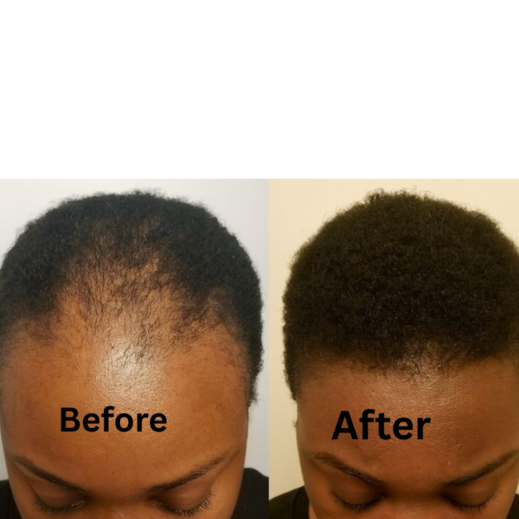 Batana Hair growth Oil. Healthy scalp, promoting hair growth. 3.4OZ